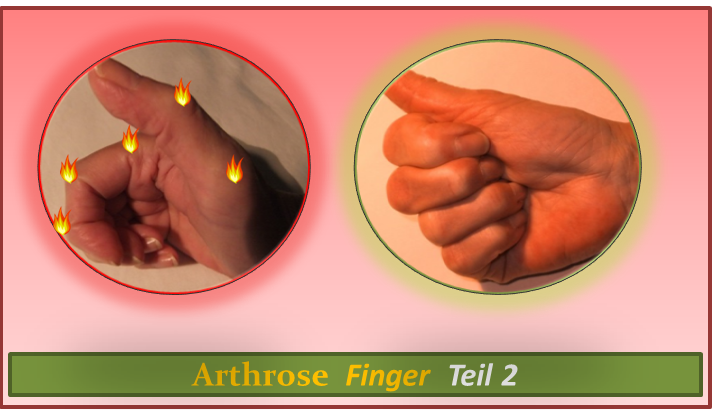 Arthrose Finger