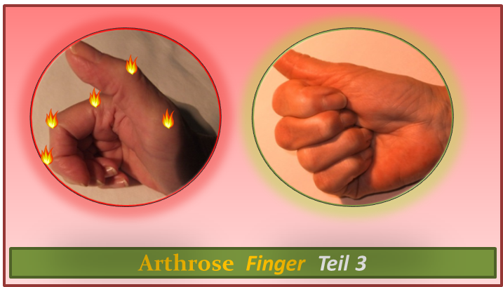 Arthrose Finger